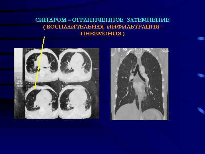 СИНДРОМ – ОГРАНИЧЕННОЕ ЗАТЕМНЕНИЕ  ( ВОСПАЛИТЕЛЬНАЯ ИНФИЛЬТРАЦИЯ –   ПНЕВМОНИЯ ) 