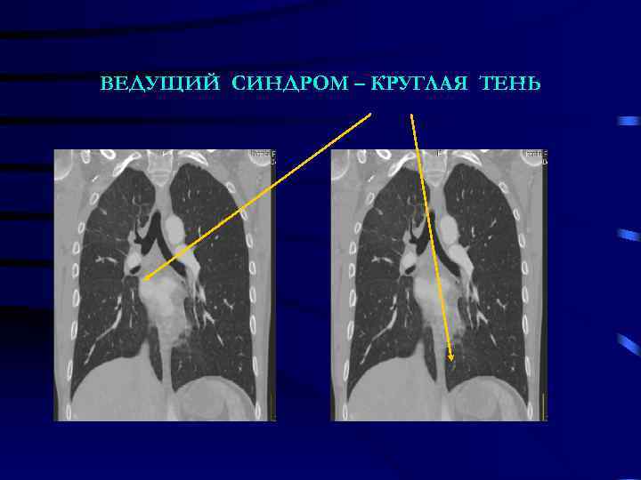 ВЕДУЩИЙ СИНДРОМ – КРУГЛАЯ ТЕНЬ 