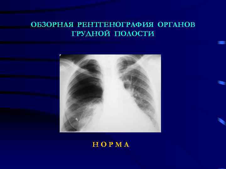 ОБЗОРНАЯ РЕНТГЕНОГРАФИЯ ОРГАНОВ   ГРУДНОЙ ПОЛОСТИ    НОРМА 
