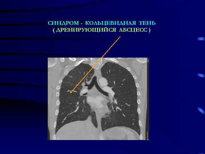СИНДРОМ - КОЛЬЦЕВИДНАЯ ТЕНЬ ( ДРЕНИРУЮЩИЙСЯ АБСЦЕСС ) 