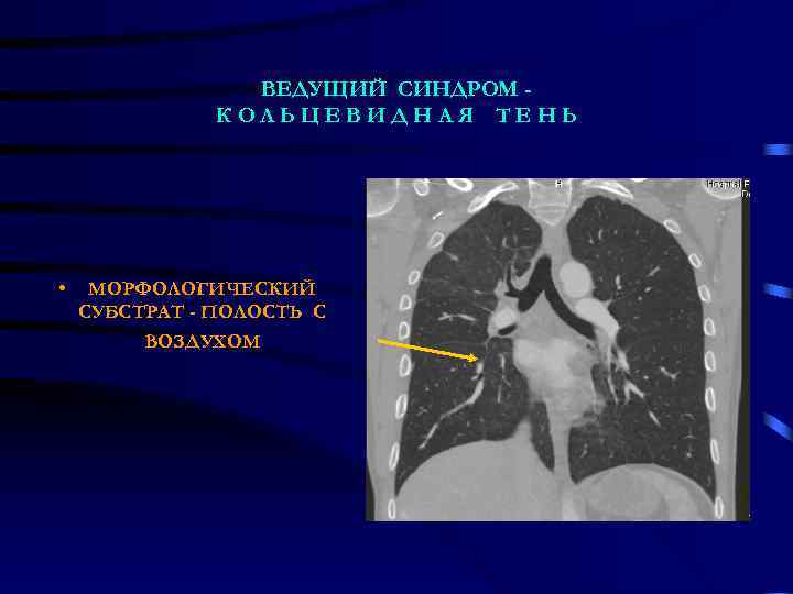    ВЕДУЩИЙ СИНДРОМ -    КОЛЬЦЕВИДНАЯ ТЕНЬ • МОРФОЛОГИЧЕСКИЙ СУБСТРАТ