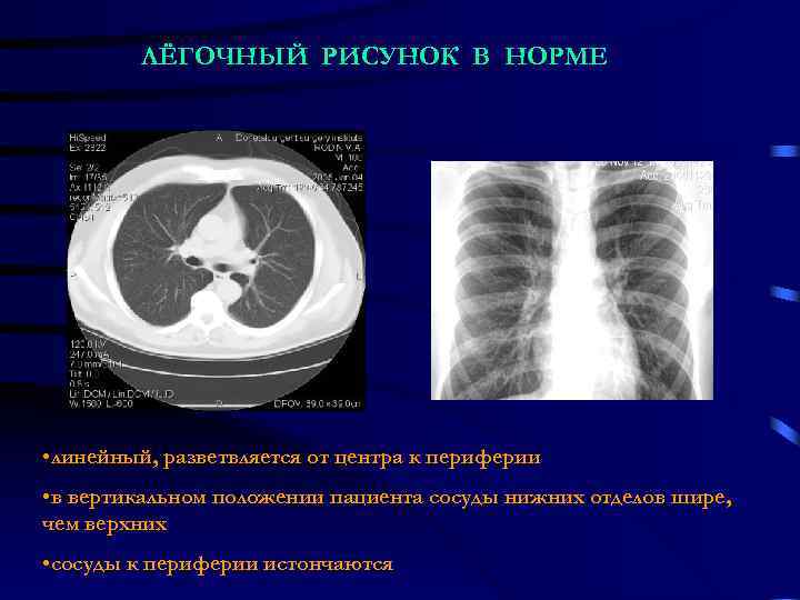    ЛЁГОЧНЫЙ РИСУНОК В НОРМЕ • линейный, разветвляется от центра к периферии