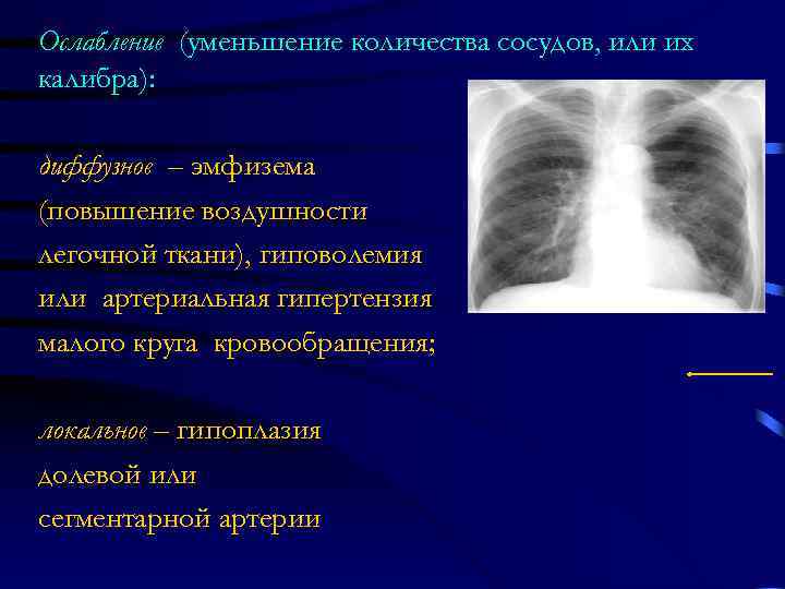 Ослабление (уменьшение количества сосудов, или их калибра):  диффузное – эмфизема (повышение воздушности легочной