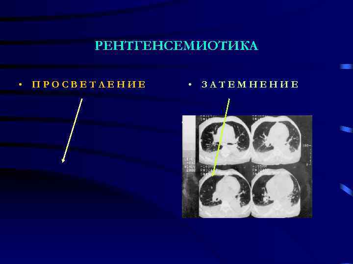   РЕНТГЕНСЕМИОТИКА  • ПРОСВЕТЛЕНИЕ  • ЗАТЕМНЕНИЕ 