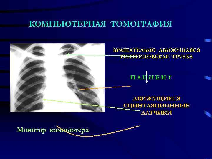  КОМПЬЮТЕРНАЯ ТОМОГРАФИЯ    ВРАЩАТЕЛЬНО ДВИЖУЩАЯСЯ    РЕНТГЕНОВСКАЯ ТРУБКА 