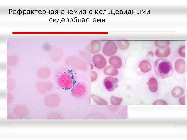 Рефрактерная анемия с кольцевидными  сидеробластами 