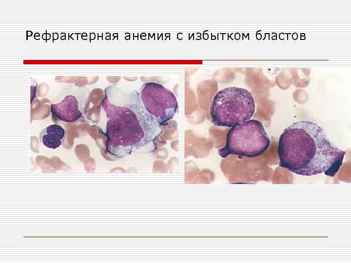 Рефрактерная анемия с избытком бластов 