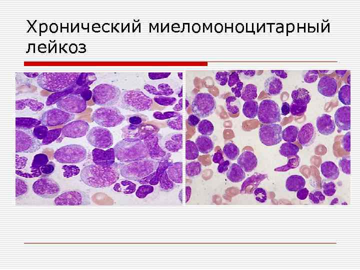 Хронический миеломоноцитарный лейкоз 