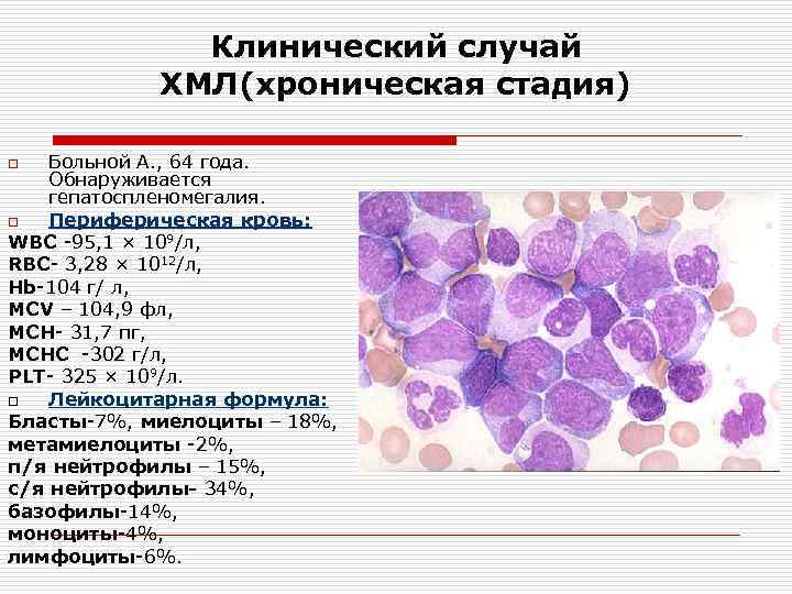    Клинический случай   ХМЛ(хроническая стадия) o  Больной А. ,