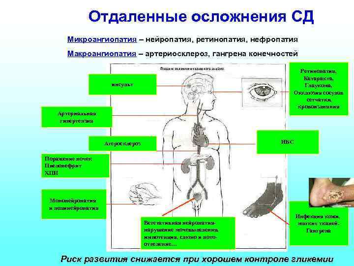 Отдаленные осложнения СД Микроангиопатия – нейропатия, ретинопатия, нефропатия Макроангиопатия – артериосклероз, гангрена конечностей Ретинопатия,