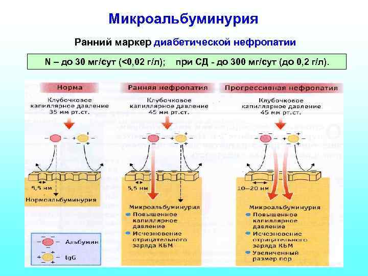 Микроальбуминурия Ранний маркер диабетической нефропатии N – до 30 мг/сут (<0, 02 г/л); при