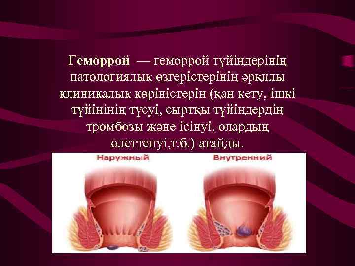  Геморрой — геморрой түйіндерінің  патологиялық өзгерістерінің әрқилы клиникалық көріністерін (қан кету, ішкі