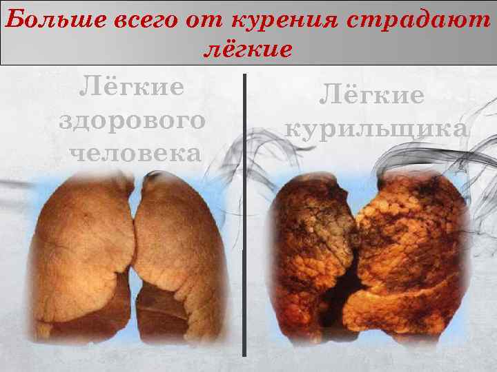 Больше всего от курения страдают    лёгкие Лёгкие  здорового курильщика человека