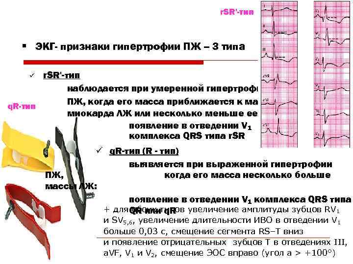      r. SR'-тип § ЭКГ- признаки гипертрофии ПЖ – 3