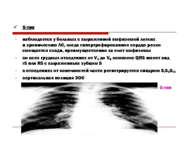 ü  S-тип −  наблюдается у больных с выраженной эмфиземой легких и хроническим