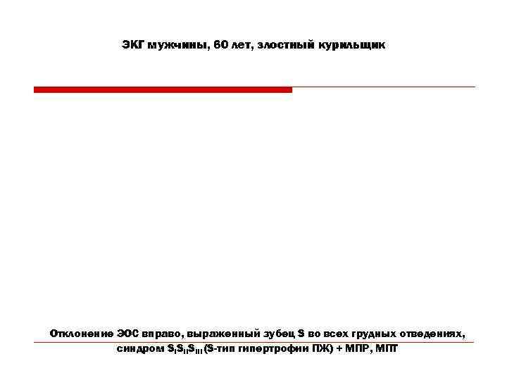   ЭКГ мужчины, 60 лет, злостный курильщик Отклонение ЭОС вправо, выраженный зубец S