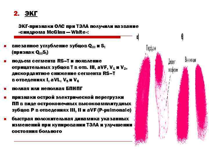 Экг при тэла картинки