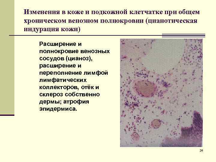 Хроническое венозное полнокровие печени микропрепарат рисунок