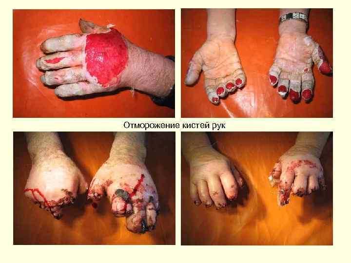 Отморожение кистей рук 