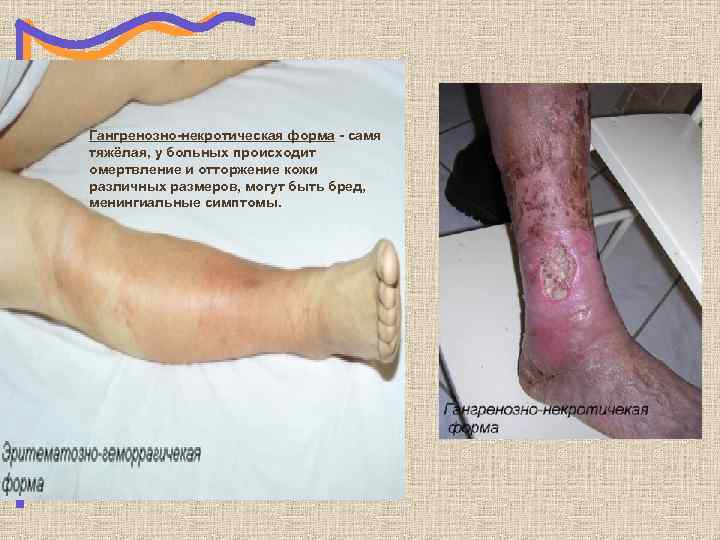 Гангренозно-некротическая форма - самя тяжёлая, у больных происходит омертвление и отторжение кожи различных размеров,