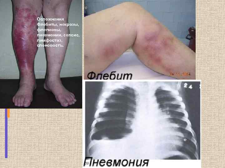 Осложнения Флебиты, некрозы, флегмоны, пневмонии, сепсис, лимфостаз, слоновость. 