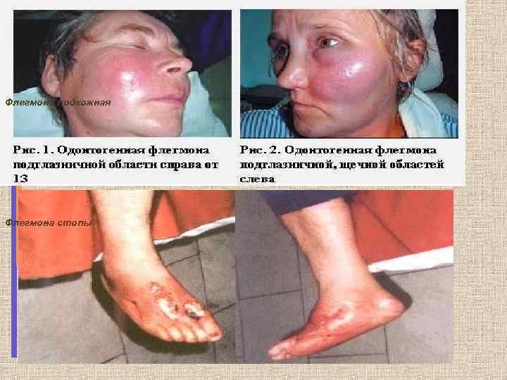Флегмона подкожная Флегмона стопы 