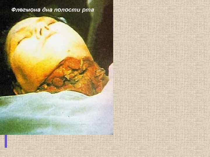 Флегмона дна полости рта 