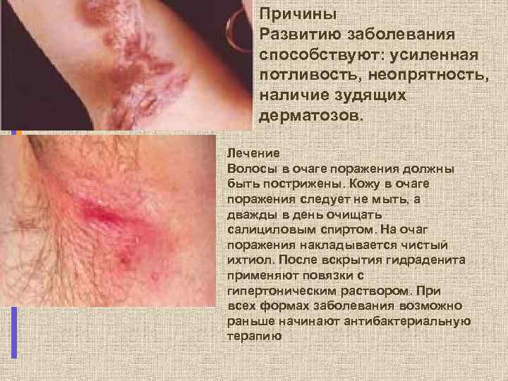 Причины Развитию заболевания способствуют: усиленная потливость, неопрятность, наличие зудящих дерматозов. Лечение Волосы в очаге