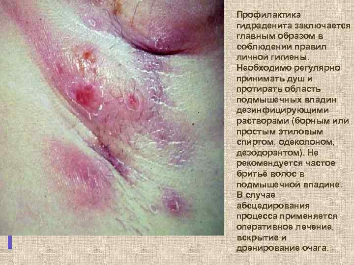 Профилактика гидраденита заключается главным образом в соблюдении правил личной гигиены. Необходимо регулярно принимать душ