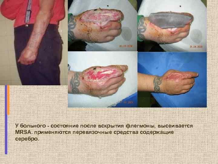У больного - состояние после вскрытия флегмоны, высеивается MRSA. применяются перевязочные средства содержащие серебро.