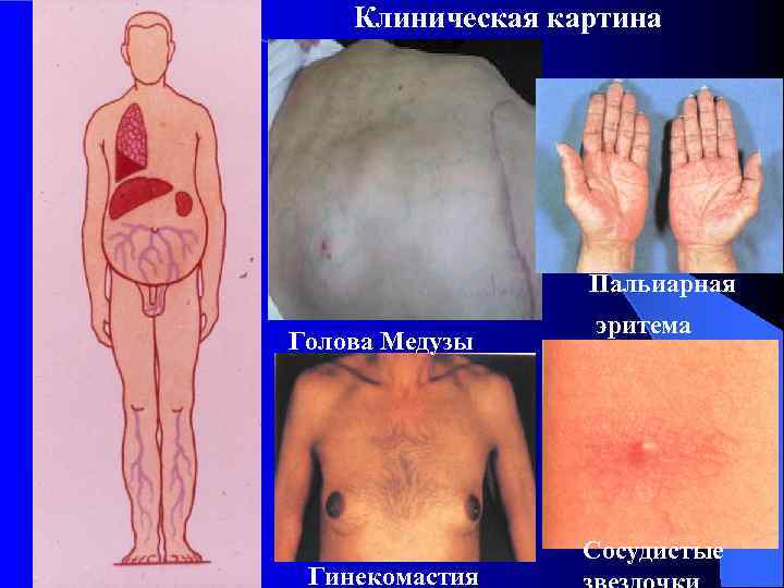 Клиническая картина Пальиарная Голова Медузы Гинекомастия эритема Сосудистые 