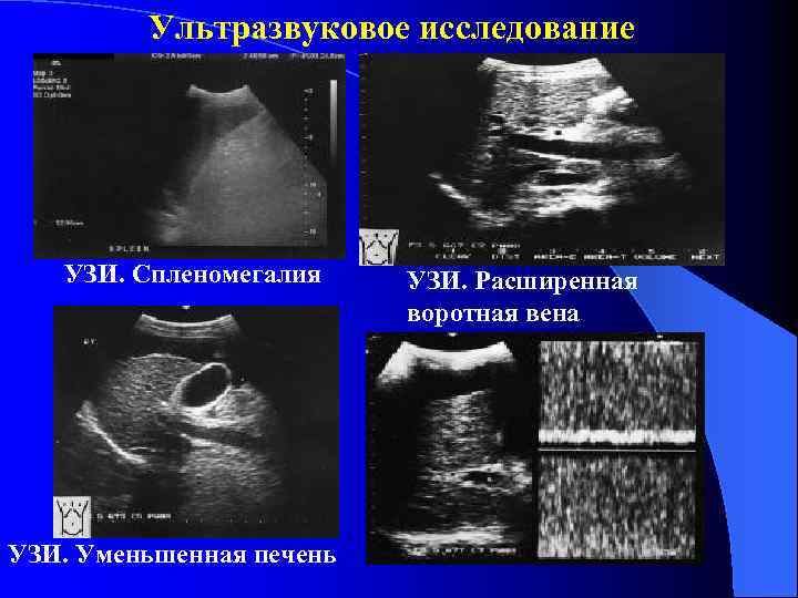 Ультразвуковое исследование УЗИ. Спленомегалия УЗИ. Уменьшенная печень УЗИ. Расширенная воротная вена 