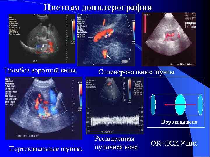 Цветная допплерография Тромбоз воротной вены. Спленоренальные шунты Воротная вена Портокавальные шунты. Расширенная пупочная вена