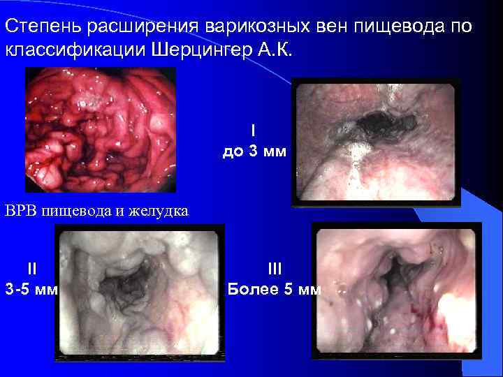 Степень расширения варикозных вен пищевода по классификации Шерцингер А. К. I до 3 мм