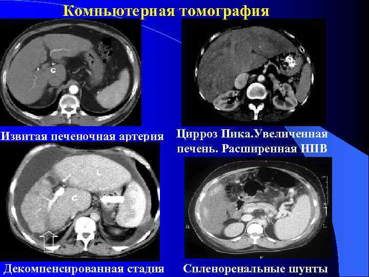 Компьютерная томография Извитая печеночная артерия Цирроз Пика. Увеличенная печень. Расширенная НПВ Декомпенсированная стадия Спленоренальные