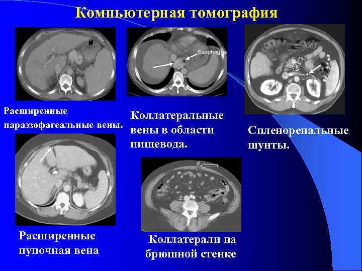 Компьютерная томография Расширенные параэзофагеальные вены. Расширенные пупочная вена Коллатеральные вены в области пищевода. Коллатерали