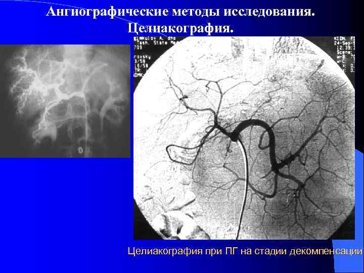 Ангиографические методы исследования. Целиакография при ПГ на стадии декомпенсации 