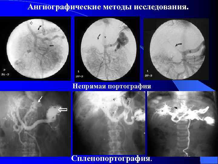 Ангиографические методы исследования. Непрямая портография Спленопортография. 