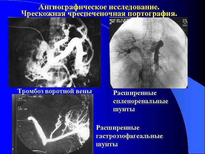 Ангиографическое исследование. Чрескожная чреспеченочная портография. Тромбоз воротной вены Расширенные спленоренальные шунты Расширенные гастроэзофагеальные шунты