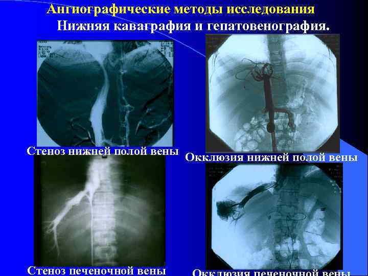 Ангиографические методы исследования Нижняя каваграфия и гепатовенография. Стеноз нижней полой вены Окклюзия нижней полой