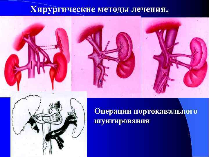 Хирургические методы лечения. Операции портокавального шунтирования 