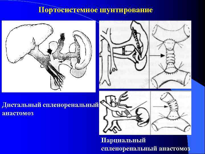 Портосистемное шунтирование Дистальный спленоренальный анастомоз Парциальный спленоренальный анастомоз 