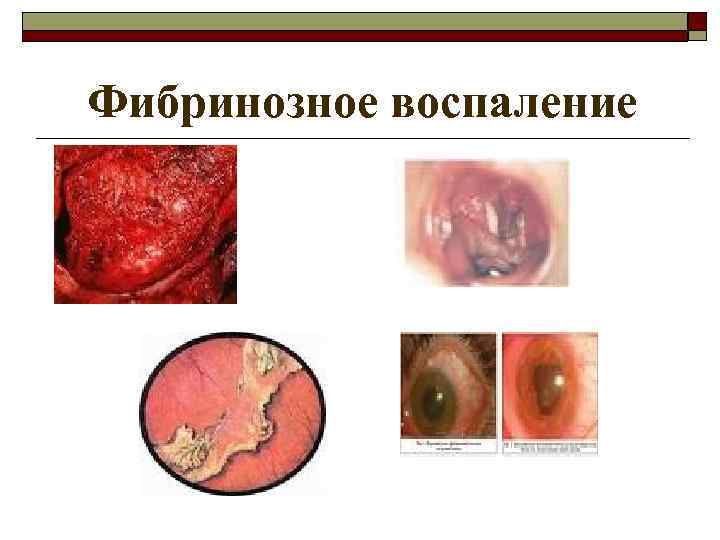Фибринозное воспаление 
