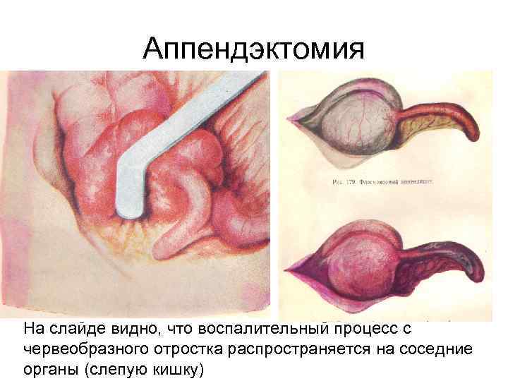 Аппендэктомия На слайде видно, что воспалительный процесс с червеобразного отростка распространяется на соседние органы