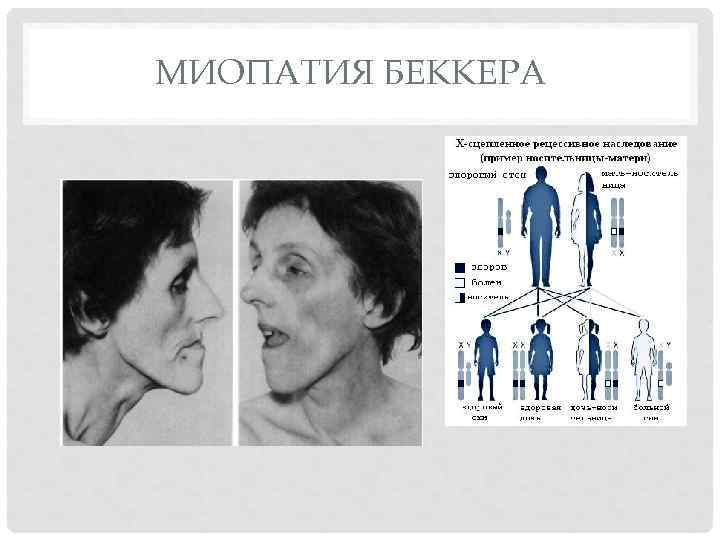 МИОПАТИЯ БЕККЕРА 