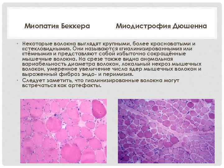  Миопатия Беккера   Миодистрофия Дюшенна  • Некоторые волокна выглядят крупными, более