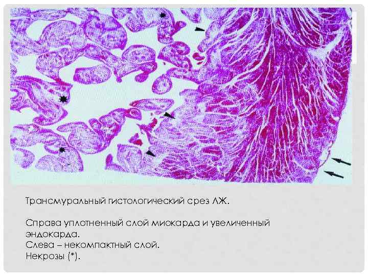 Трансмуральный гистологический срез ЛЖ.  Справа уплотненный слой миокарда и увеличенный эндокарда. Слева –