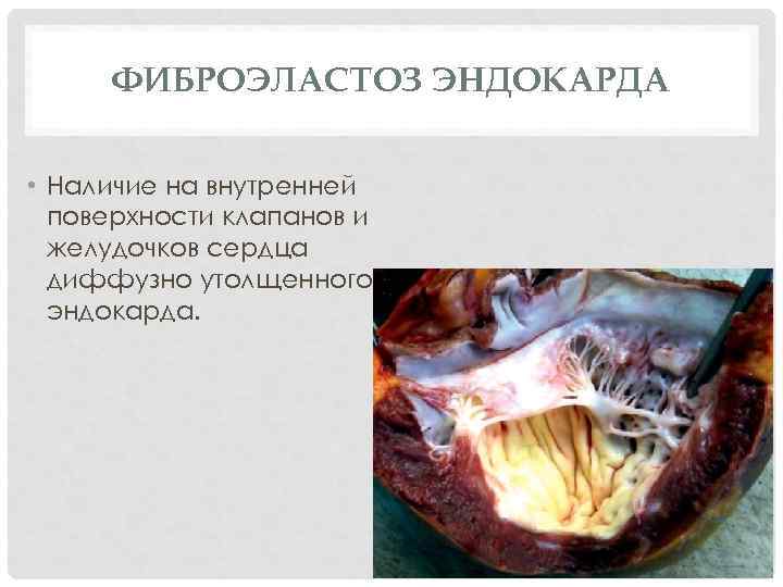  ФИБРОЭЛАСТОЗ ЭНДОКАРДА  • Наличие на внутренней  поверхности клапанов и  желудочков