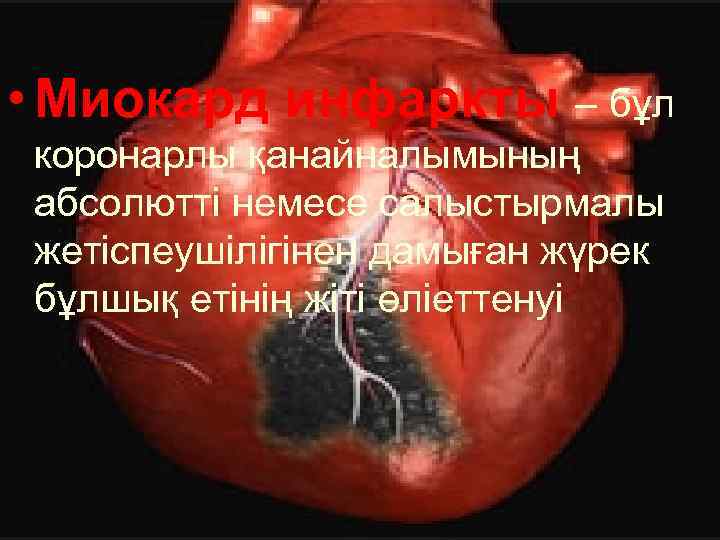  • Миокард инфаркты – бұл коронарлы қанайналымының абсолютті немесе салыстырмалы жетіспеушілігінен дамыған жүрек