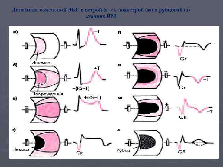 Динамика изменений ЭКГ в острой (а–е), подострой (ж) и рубцовой (з) стадиях ИМ 